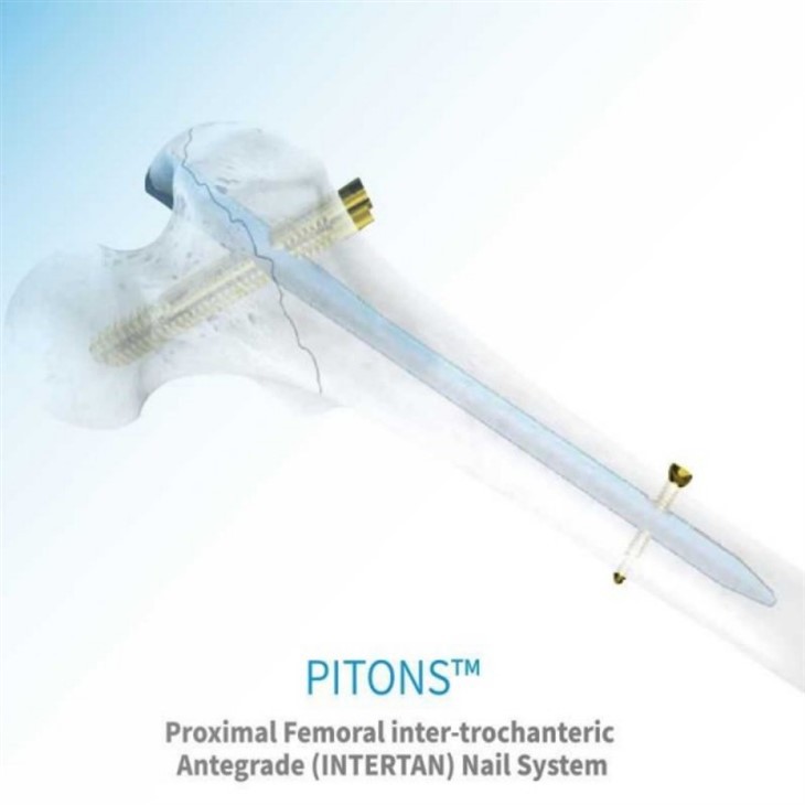 prophylactic intramedullary nailing of femur